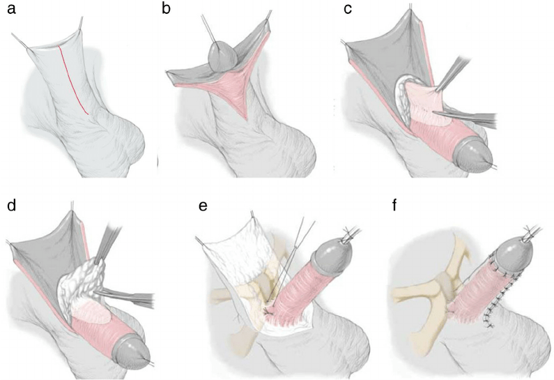 ligamentotomy for penis enlargement
