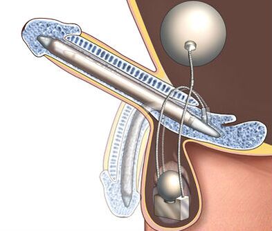 penis prosthesis to enlarge it
